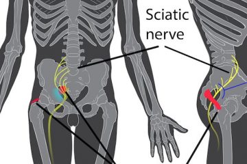 5 Tell-Tale Signs of Sciatica You Should Never Overlook