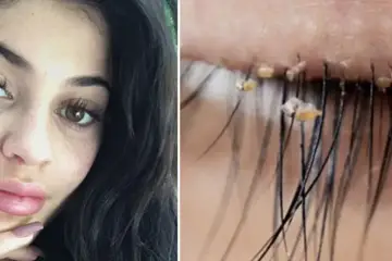 Doctors Are Warning: Lash Lice Are Becoming More Common in Eyelash Extensions