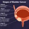 Bladder Cancer Can Be Diagnosed Early: Here Are the Major Symptoms