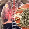 5 Revealing Signs That Your Lungs Are Being Exposed to Mold