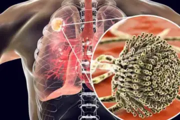5 Revealing Signs That Your Lungs Are Being Exposed to Mold