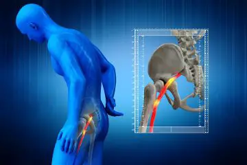 The Top 8 Natural Treatments for Sciatic Pain