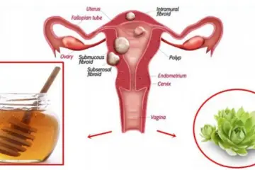 Mix These Two Ingredients & Destroy Any Cysts & Fibroids