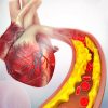 8 Ways to Stop Calcium Plaque in Your Heart Arteries