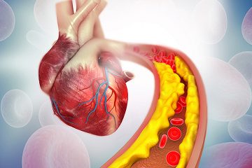 8 Ways to Stop Calcium Plaque in Your Heart Arteries