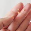 Here’s What You Need to Know About Tonsil Stones