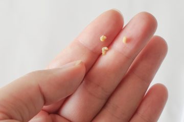 Here’s What You Need to Know About Tonsil Stones