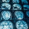 MRI Scans Cause Formation of Harmful Materials in the Body, New Study Reveals