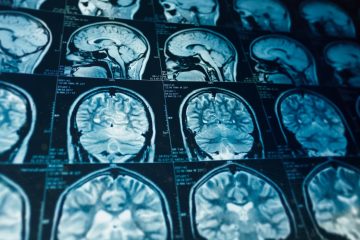 MRI Scans Cause Formation of Harmful Materials in the Body, New Study Reveals