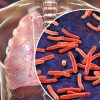 The World Has A New Leading Infectious Killer – And It’s Not COVID-19